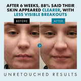 Eclat Skincare Spot Treatment for Face - Salicylic Acid Pimple Spot Treatment for Face - Spot Cream Pimple Cream Facial Blemish Spot Treatment - Cystic Hormonal Spot Treatment Face Moisturizer